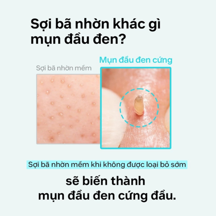 Ủ Mụn ILSO Super Melting Sebum Softener là dung dịch làm mềm những phần mụn đầu đen