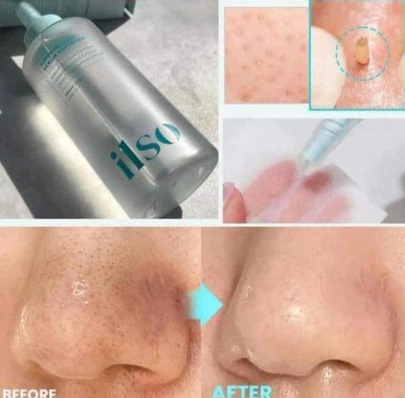 Tinh Chất Ủ Mụn Đầu Đen ILSO Sebum Super Melting Serum Softener 150mL