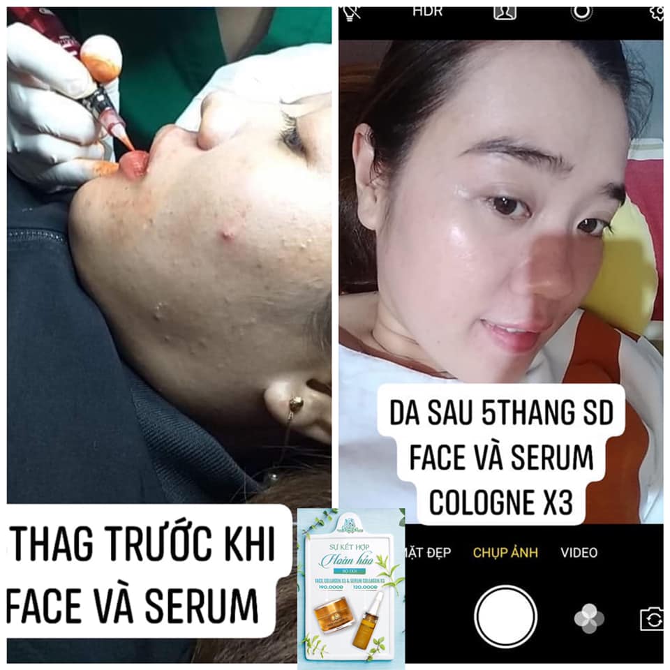Combo dưỡng da, phục hồi hư tổn da (gồm Kem face Collagen x3 và Serum Collagen x3)