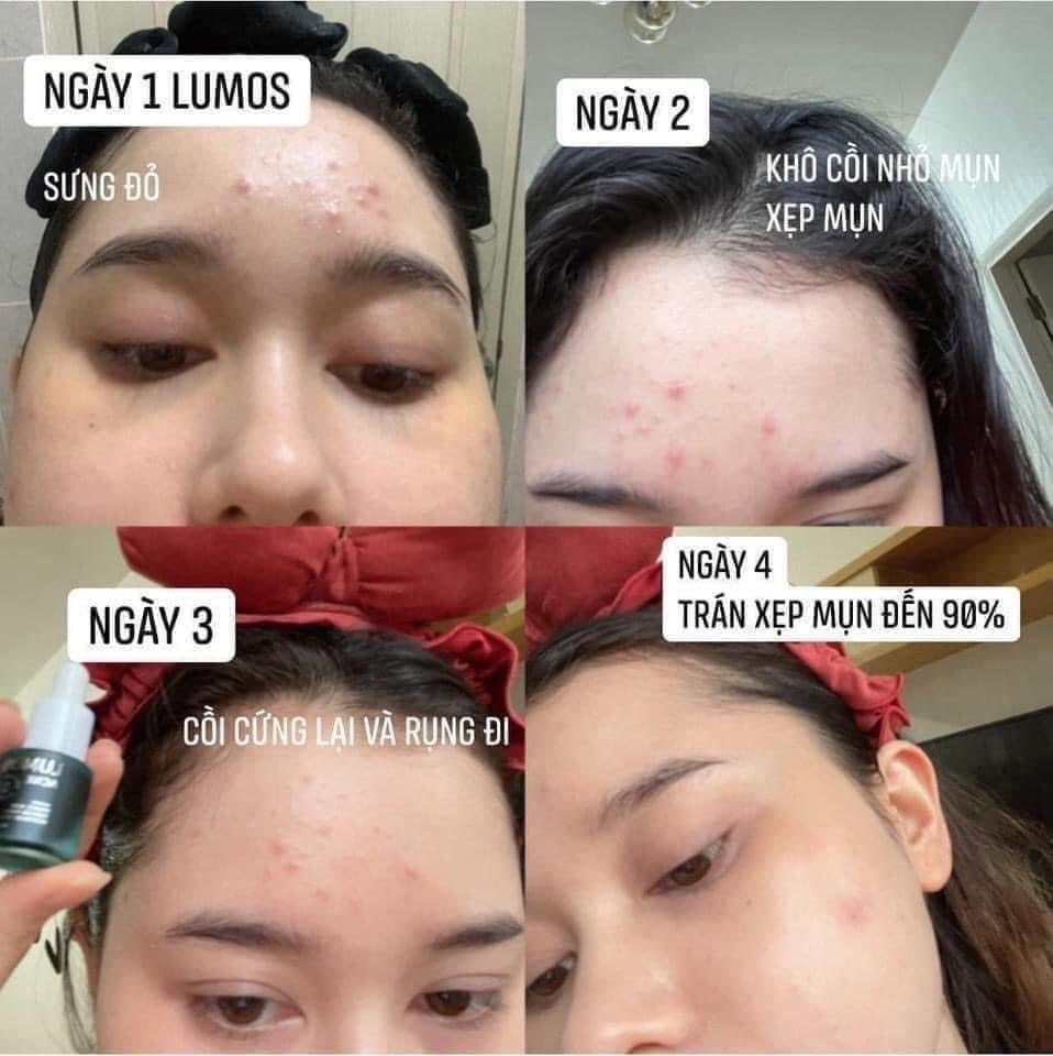 Serum trị mụn lumos phải gọi là đỉnh của đỉnh về trị mụn lun đó ạ