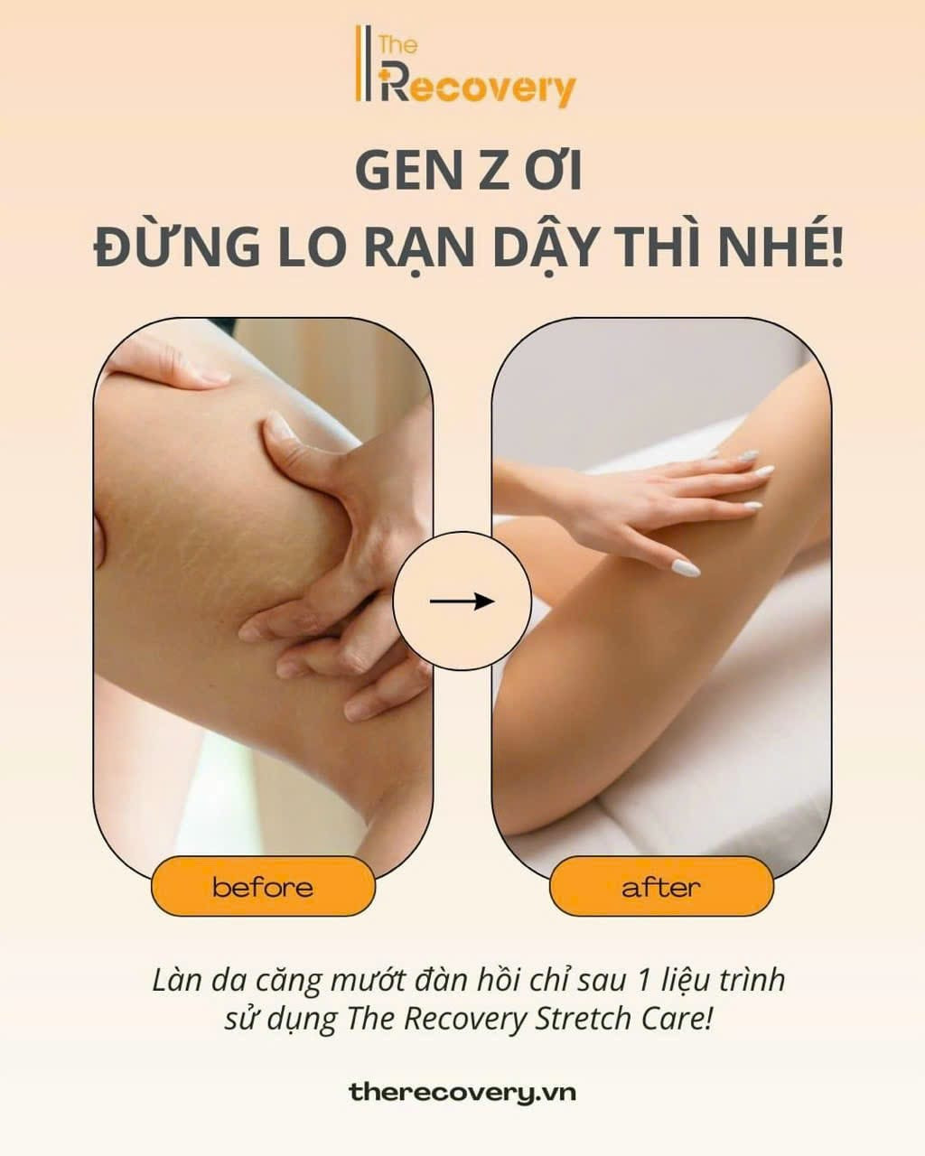 Đừng để rạn da do tăng cân làm bạn mất tự tin